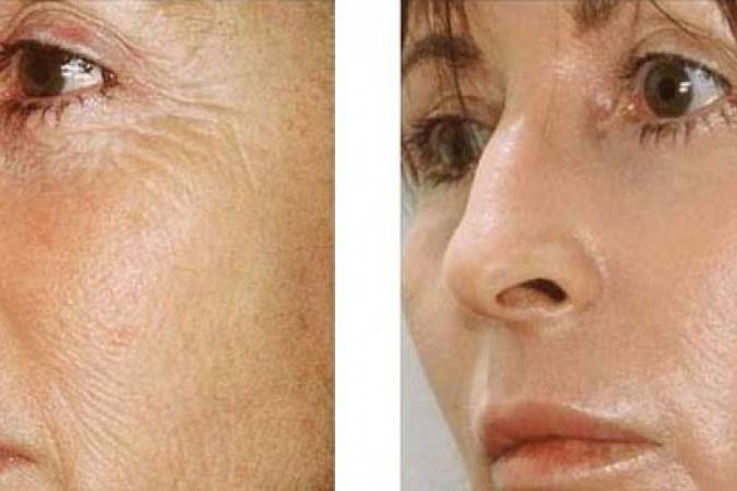 Глубокий феноловый пилинг: реальное омоложение или неоправданный риск