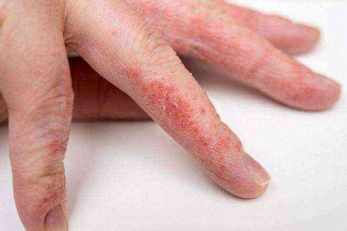 От чего шелушится кожа между пальцев рук