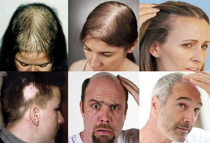 Почему выпадают волосы на голове у женщин и мужчин и что с этим делать