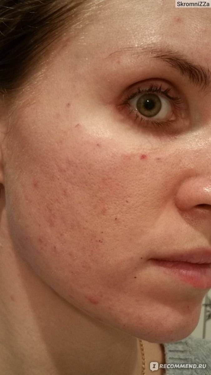 Мезотерапия тела для похудения – отзывы, инъекции липолитиков в живот