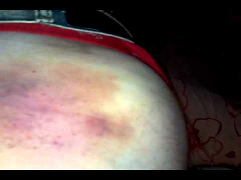 Как восстановить лицо после мезотерапии – рекомендации от врачей косметологов