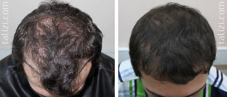 Форум после пересадки. Волосы после пересадки волос. Операция по пересадке волос.