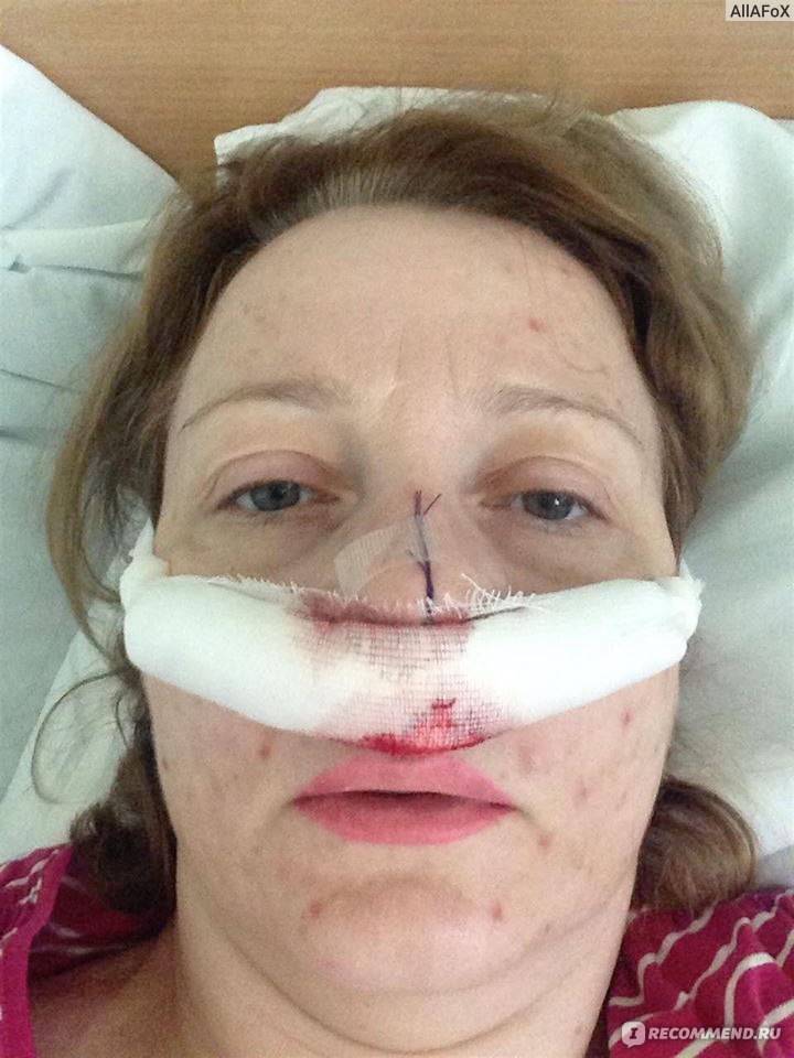 Операция по выпрямлению носовой перегородки – показания к поведению и ход процедуры +видео