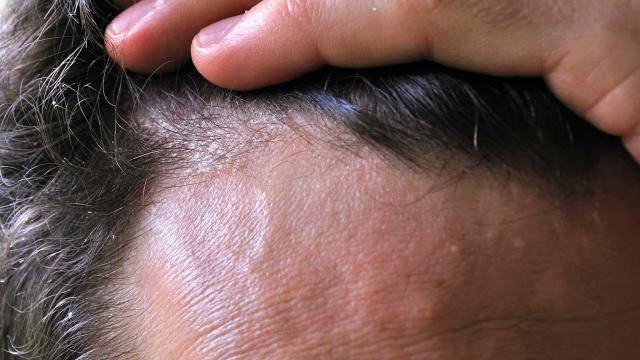 Чешется и колется: каковы причины зуда на коже головы и какое существует лечение?