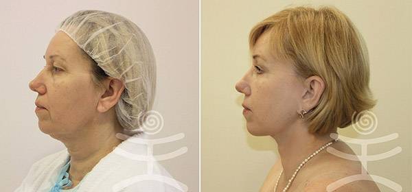 В чем отличие спейслифтинга от лифтинга мендельсона? - 300 экспертов.ру