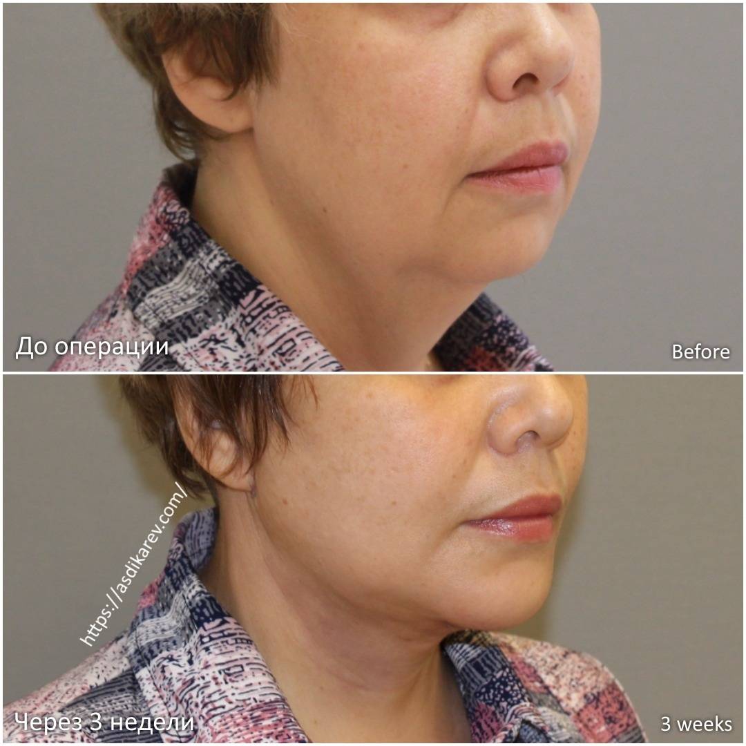 Эндоскопическая подтяжка средней зоны лица: разновидности и результативность процедуры