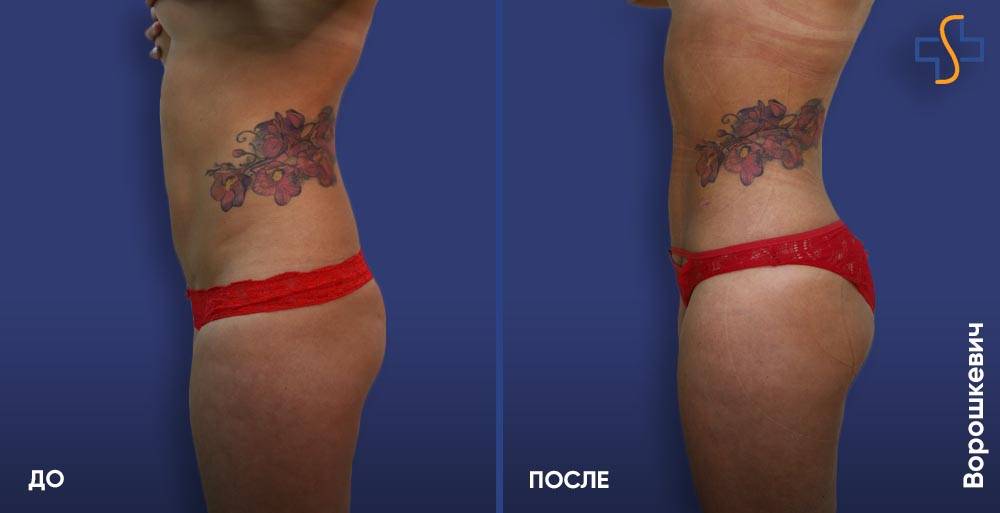 Липофилинг ягодиц: как проводят, плюсы и минусы метода, результат и реабилитация