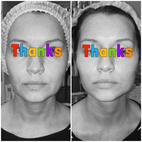 Разбираемся зачем делать биоревитализацию revi и какой будет эффект