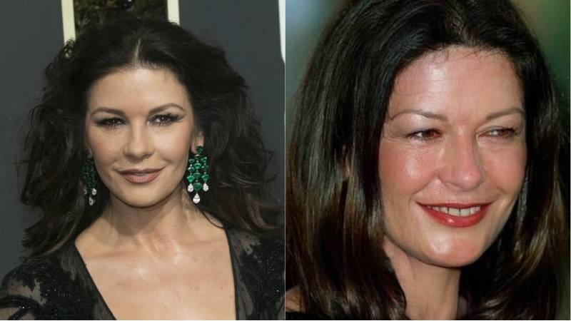 Звезды с "пластиковым" лицом: российские, голливудские - 24сми