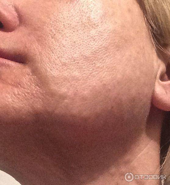 Редермализация кожи гиалуаль (hyalual): суть метода, линейка препарата, цена