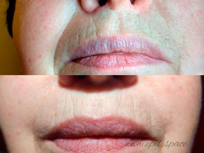 Фотоэпиляция усиков: показания и противопоказания, отзывы, на сколько хватает