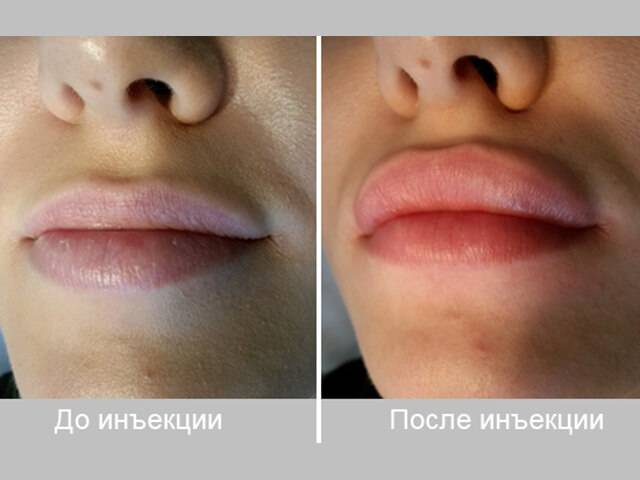 Какой филлер лучше использовать для увеличения губ и как проходит процедура?