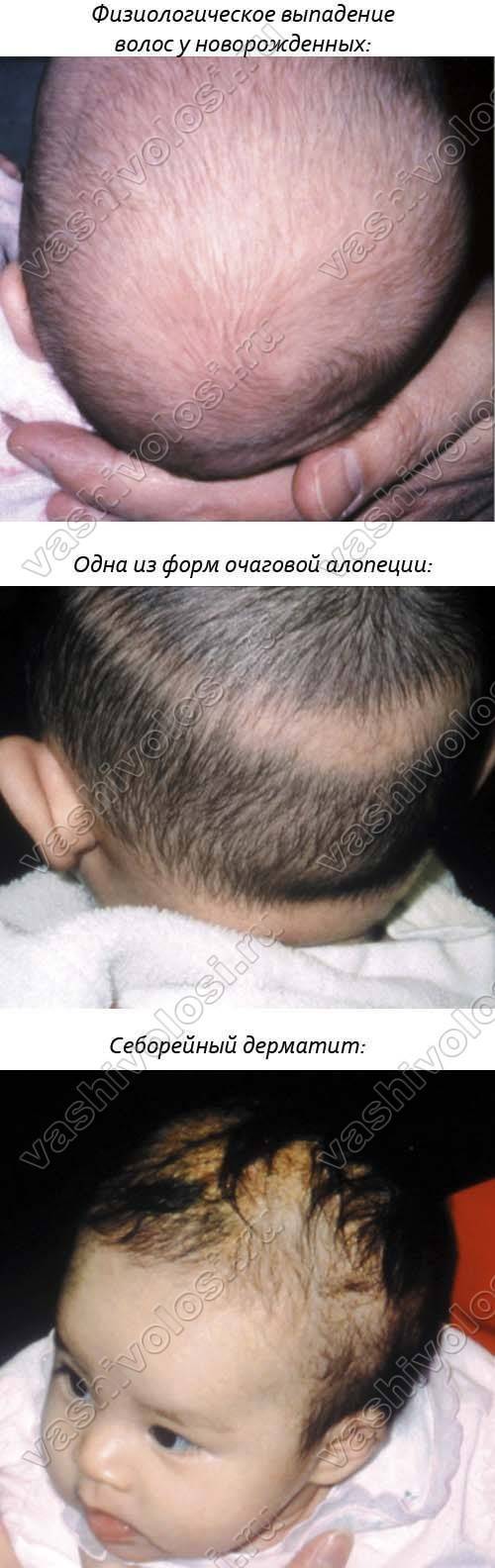 Комаровский - у ребенка выпадают волосы: что делать, у детей до года
