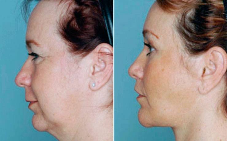 Ментопластика: отзывы пациентов, фото до и после пластики подбородка, цена на костную коррекцию верхней и нижней челюсти, трети лица, гениопластику, как убрать второй подбородок, как проходит операция