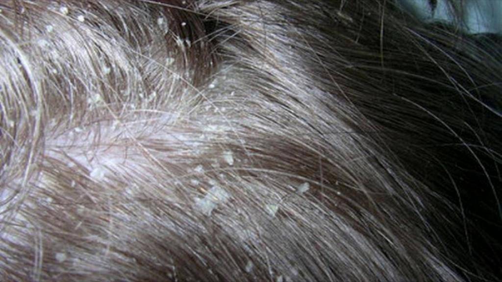 Какие травы помогают от перхоти, зуда и выпадения волос: основные рецепты отваров