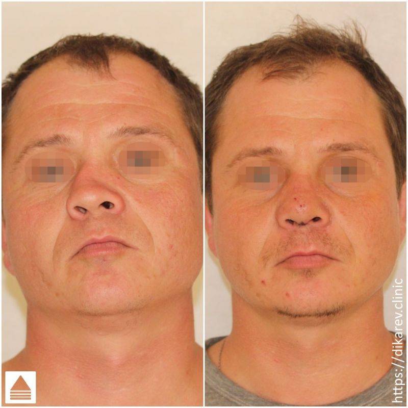 Лазерная ринопластика носа - цена и отзывы | ринопластика носа