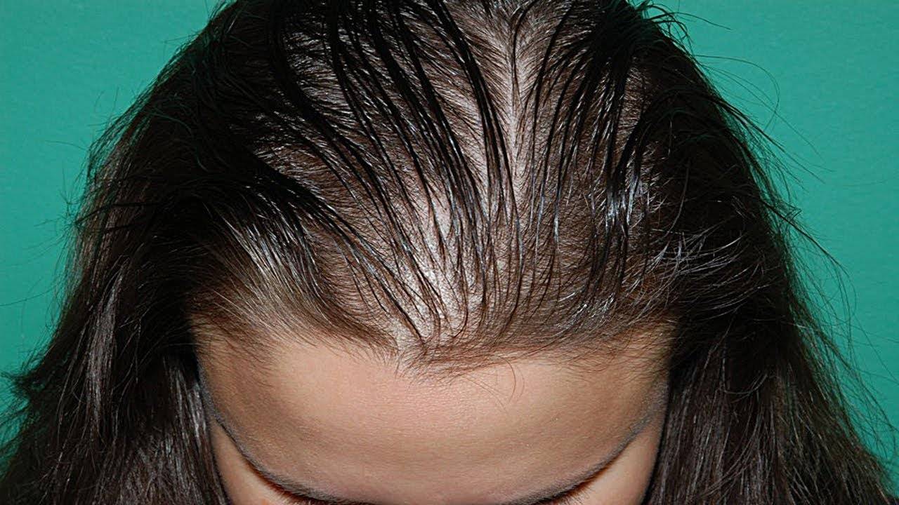 Выпадение волос у женщин - обзор самых эффективных рецептов народной медицины и лечебной косметики