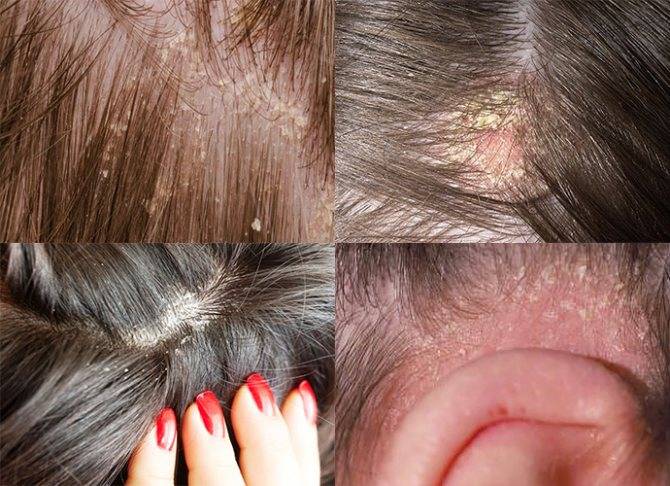 Шелушится кожа на голове - причины и методы лечения
