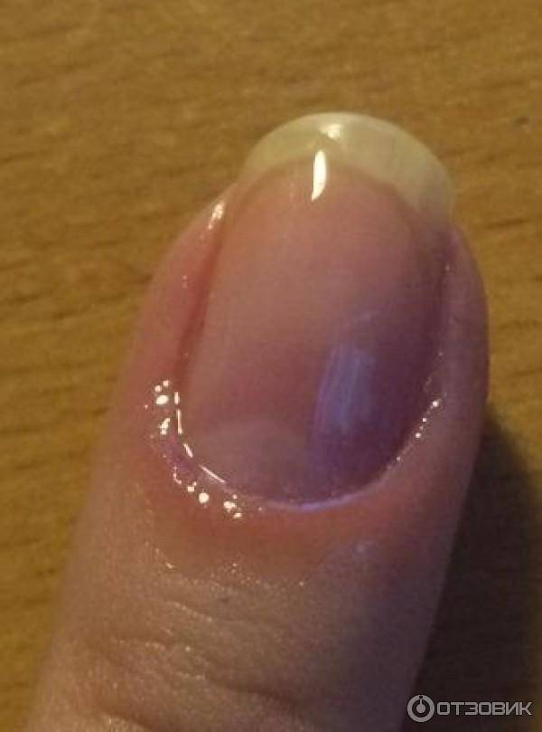 Как лечить воспаленную кутикулу ногтей