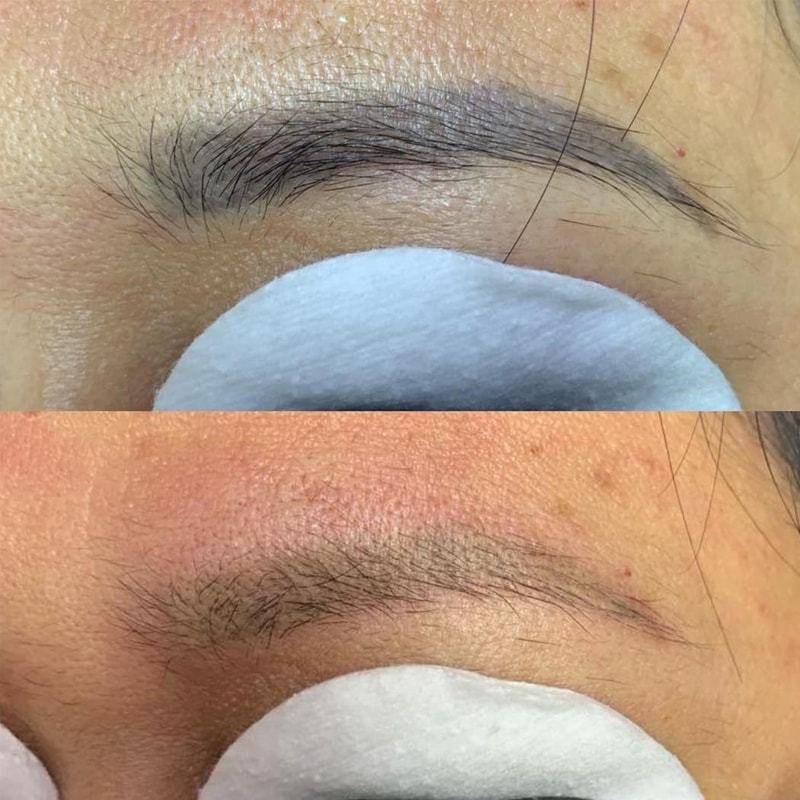 Удаление татуажа