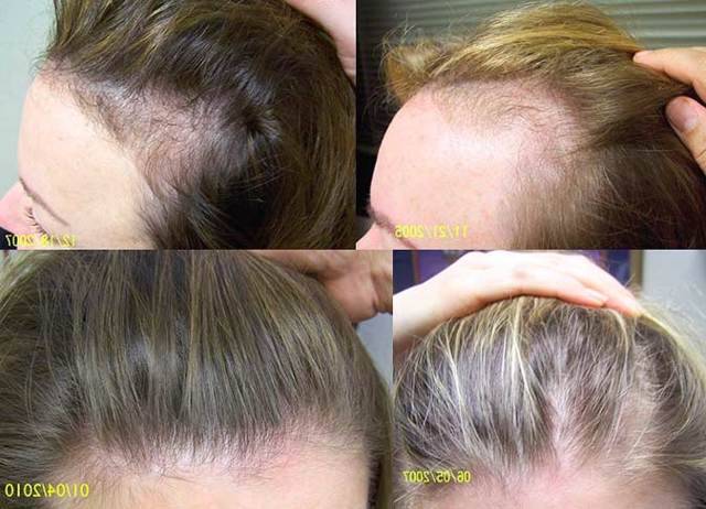 Облысение у женщин: причины и лечение. как сохранить волосы?
