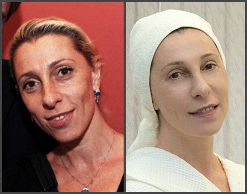 Юлия рутберг до и после пластической операции фото биография личная жизнь семья