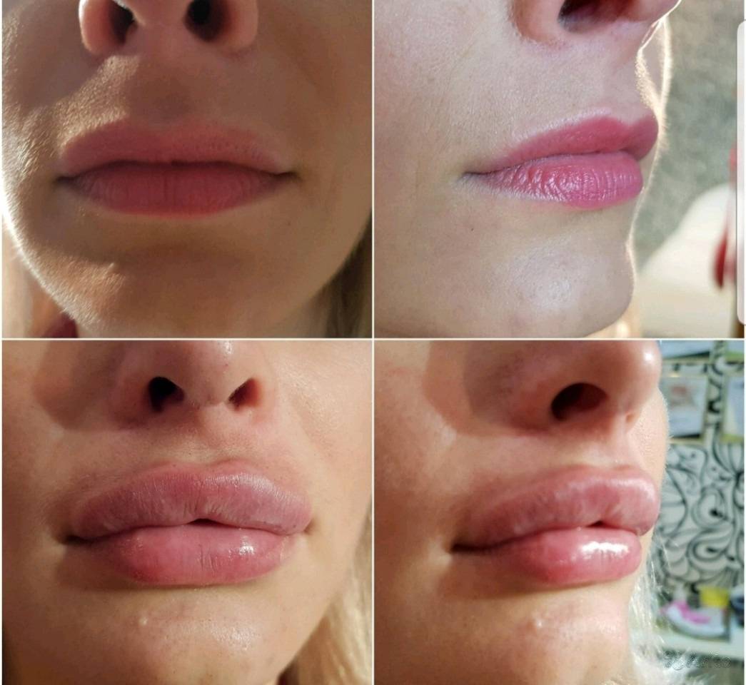 Когда можно целоваться после губ. Накачивание губ гиалуроновой кислотой 1 мл. Контурирование губ гиалуроновой кислотой.