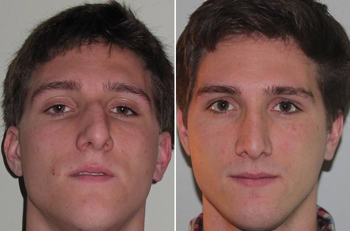 Лазерная септопластика носовой перегородки - цена, фото и отзывы