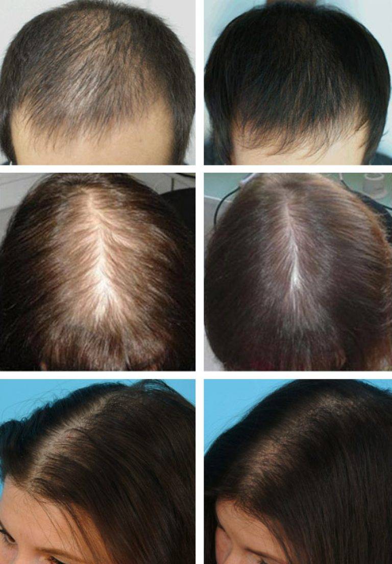 Алопеция у женщин лечение отзывы. Андрогенная алопеция алопеция. Дарсонваль алопеция андрогенная. Прически при облысении. Редеют волосы.