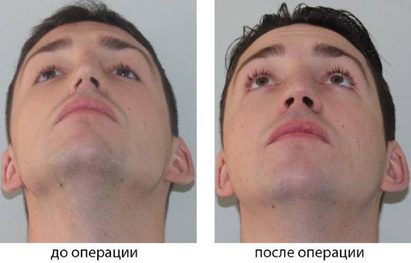 Можно выпрямить выпрямить нос. После операции на перегородку носа. Выпрямление носовой перегородки. Операция по выпрямлению носовой перегородки.