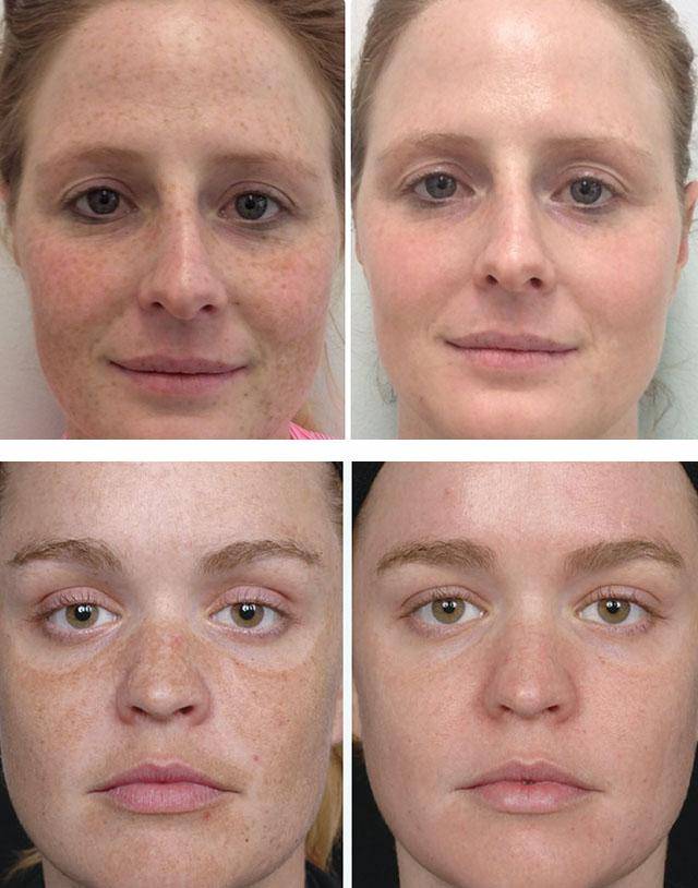 Как убрать на лице. Отбеливание кожи лица лазером. Лазерное отбеливание кожи LJ B gjckt. Пигментация на лице до и после.