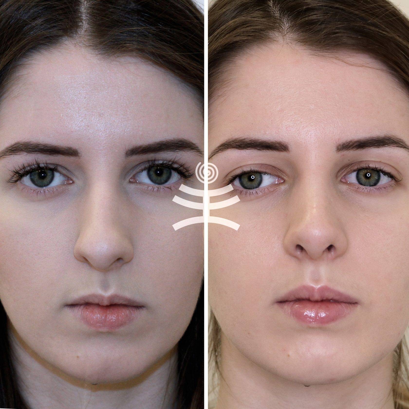 Как нос сделать визуально меньше с помощью корректора. как макияжем уменьшить нос