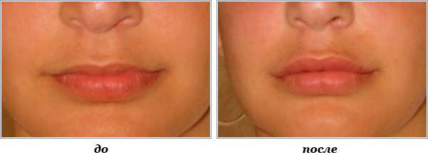 Увеличение губ усы гиалуроновые