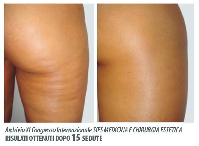 Что такое эндосфера-терапия?