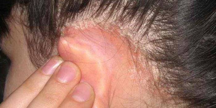 Кожа головы чешется и шелушится болячки лечение — волосы