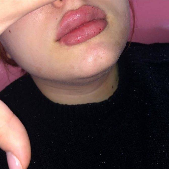Синяки после увеличения губ гиалуроновой кислотой чем лечить