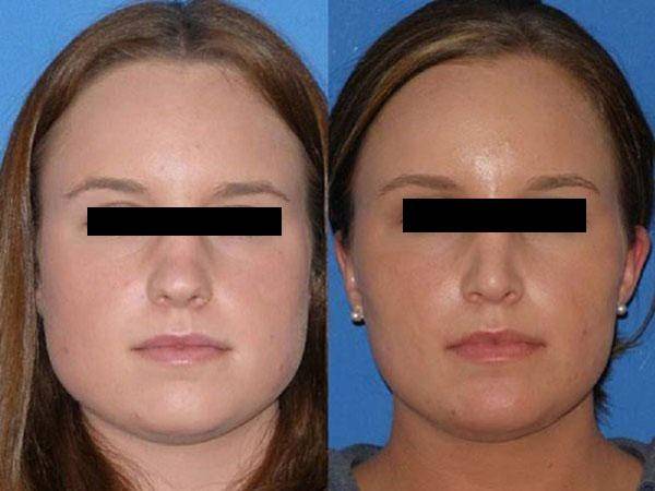 Комки биша: удаление, последствия, фото звезд до и после + видео и отзывы