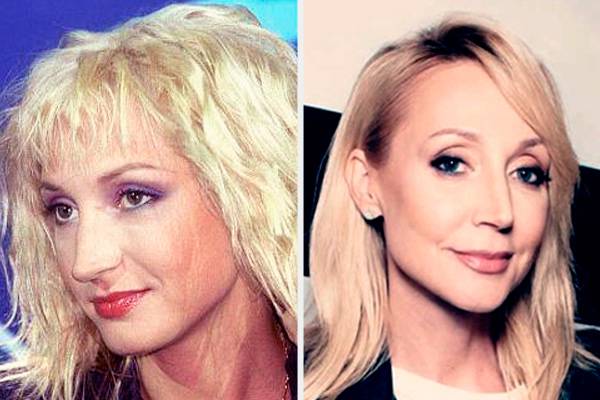Российские звезды до и после пластики на фото