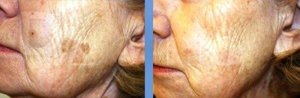 Пигментные пятна на лице: причины, лечение