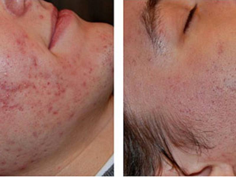 Жёлтый пилинг или тса, молочный или миндальный, гликолевый или ретиноевый – какой пилинг эффективнее и лучше?