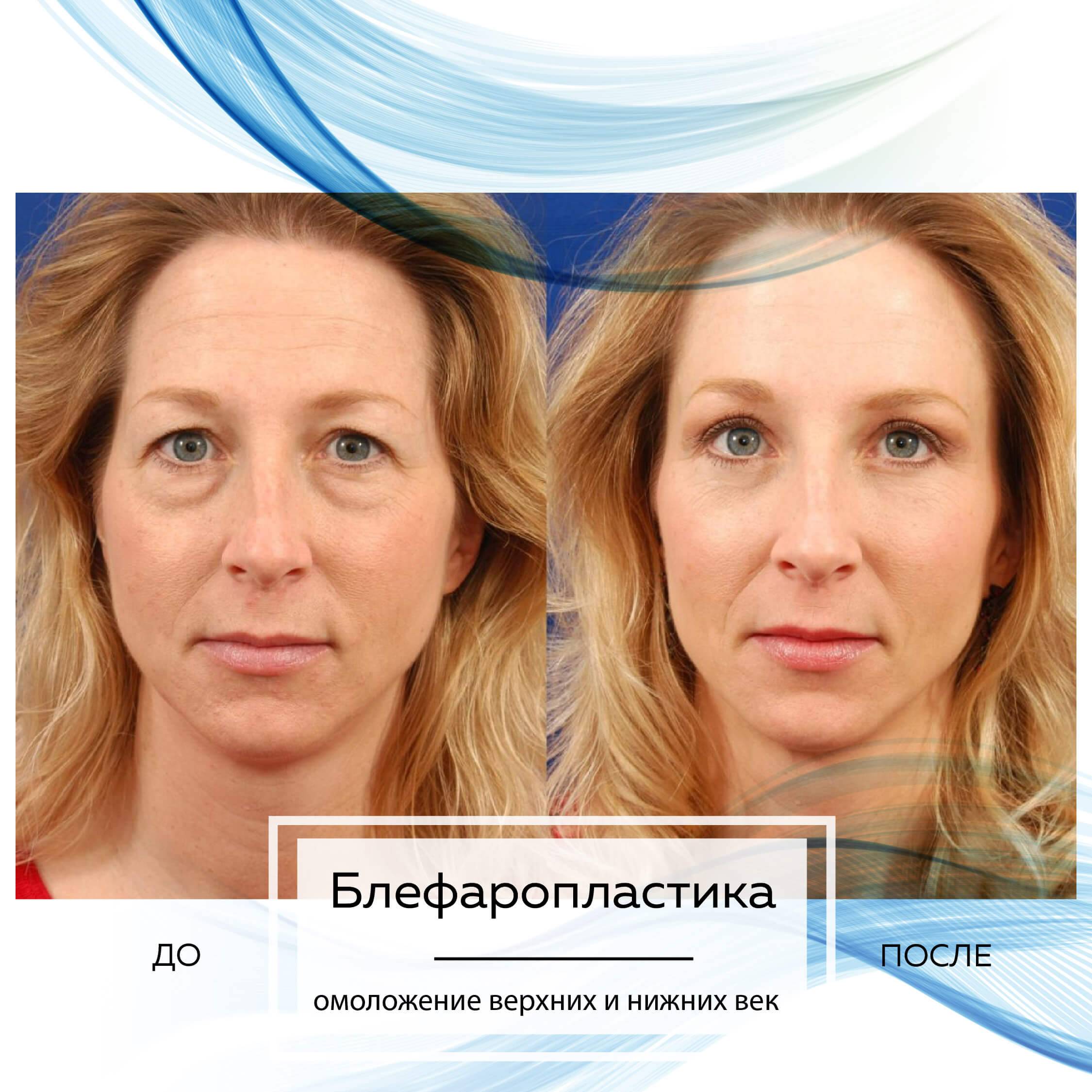 Лазерная блефаропластика, все пластические хирурги в москве - адреса, цены, отзывы, запись онлайн — kleos.ru