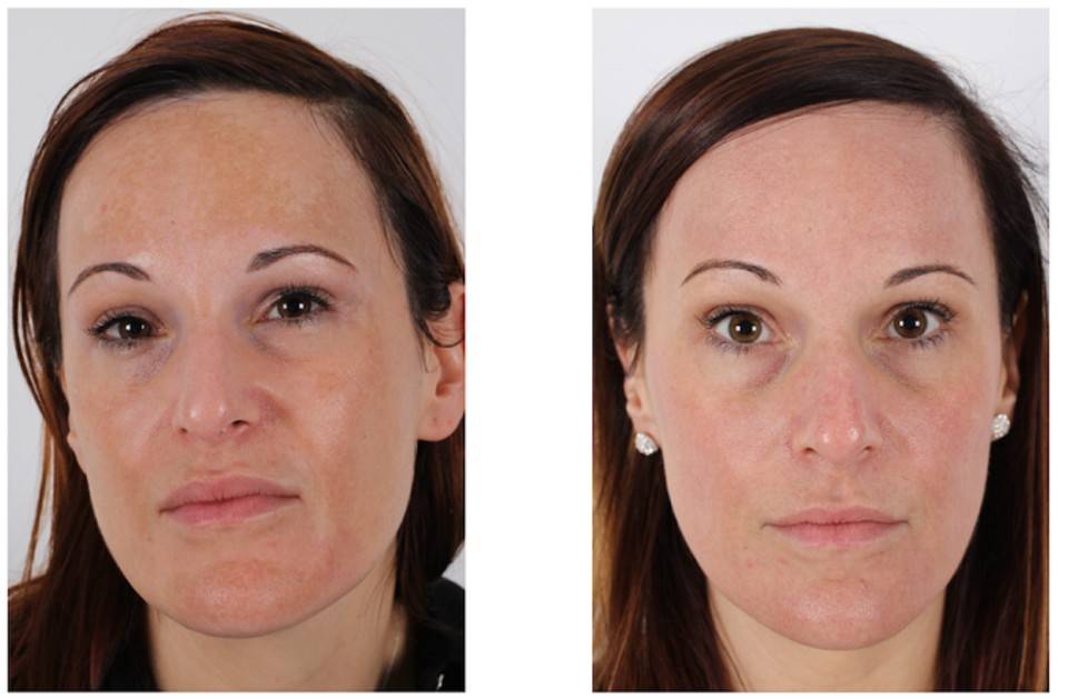 Фотоомоложение лица в салоне и дома: отзывы