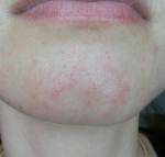 Прыщи на подбородке у мужчин, причины высыпаний и лечение
прыщи на подбородке у мужчин, причины высыпаний и лечение