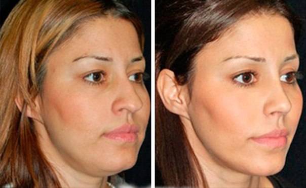 Комки биша: что это такое, фото до и после удаления комочков, отзывы, цена, можно ли убрать мешки без операции, плюсы и минусы, возможные последствия, неудачные результаты