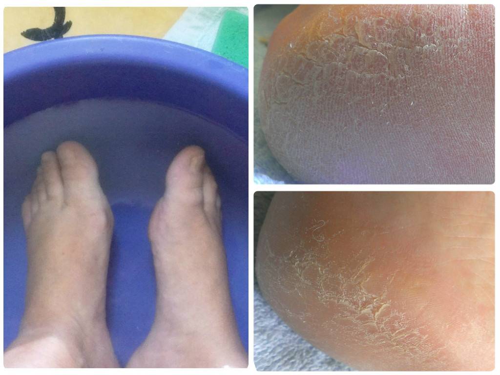 Почему шелушится кожа на ногах: причина сильной сухости и шелушения на стопе и голени, лечение и уход