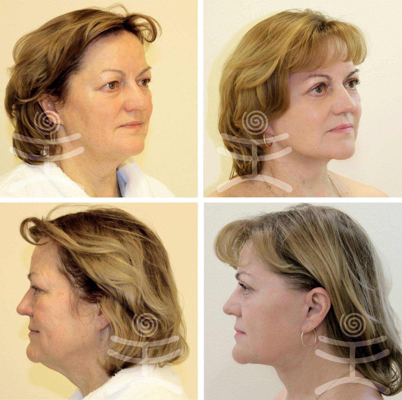 В чем отличие спейслифтинга от лифтинга мендельсона? - 300 экспертов.ру