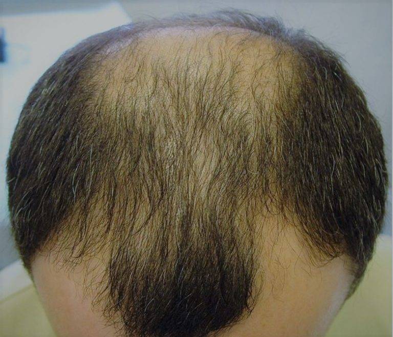 Как остановить выпадение волос у мужчины в молодом возрасте: основные причины, популярные средства и методы лечения