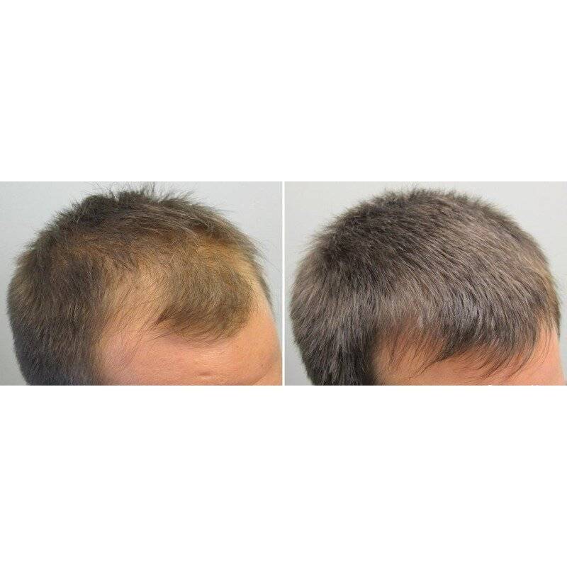 Причины выпадения волос у подростка. Андрогенная алопеция миноксидил. Андрогенная алопеция Селенцин. Миноксидил для волос для мужчин для головы.