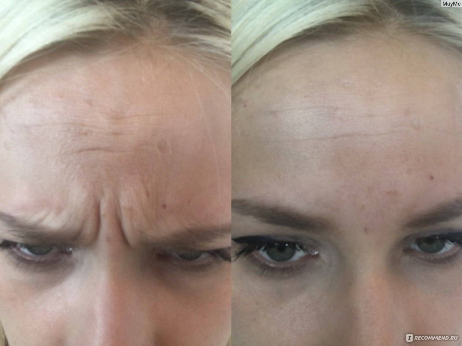 Уколы от морщин на лице фото до и после