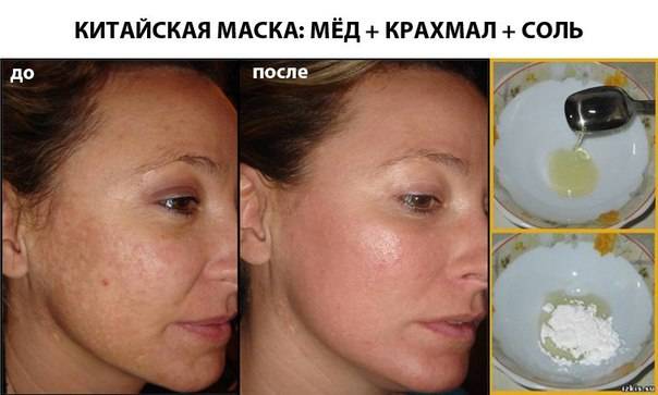 Маска для лица крахмал сметана. Маска из крахмала для лица до и после. Пигментация на лице до и после. Отбеливание кожи от пигментации. Пигментация после пилинга.